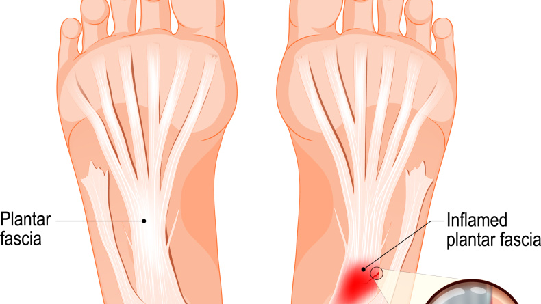 Fasciitis plantaris