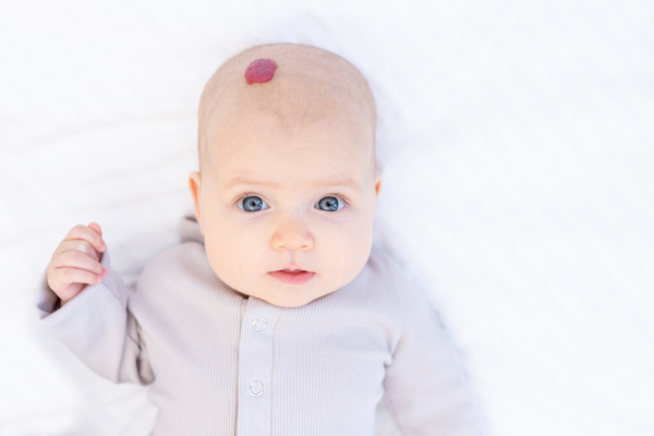 Aardbeienvlak (hemangioom) bij een baby